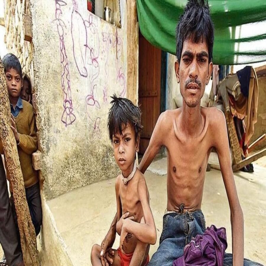 बक्सर: टीबी के मरीज अपनी डाइट में सुधार कर जल्द हो सकते हैं ठीक, जल्दी सुधर के लिए ये चीजे बहुत जरुरी हैं
